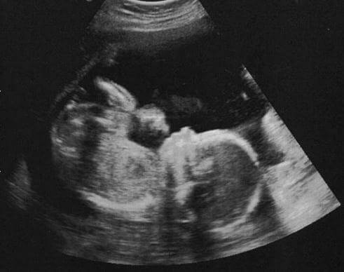 Снимок УЗИ на 20 месяце беременности